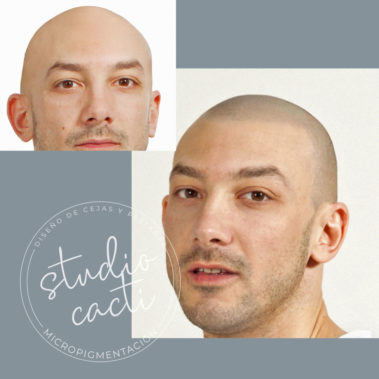 Micropigmentacion capilar Valencia