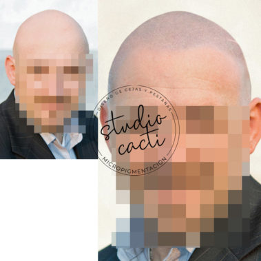 Micropigmentacion capilar Valencia