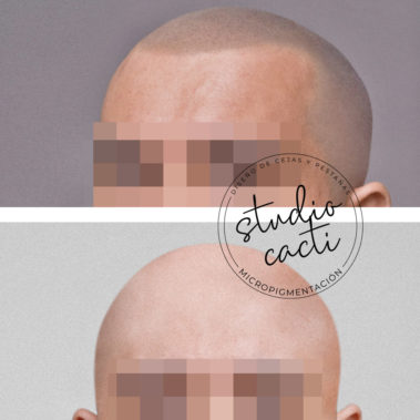 Micropigmentacion capilar Valencia