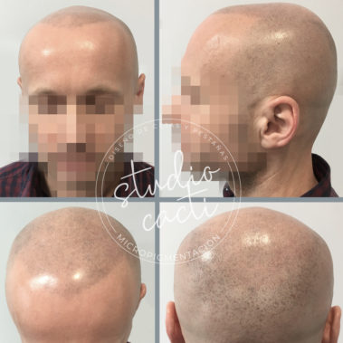 Micropigmentacion capilar Valencia