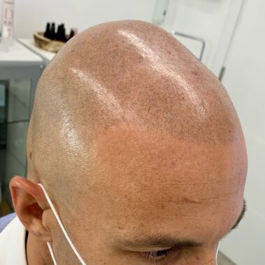 micropigmentación capilar valencia