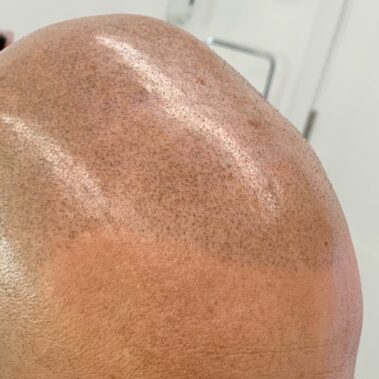 micropigmentación capilar Valencia