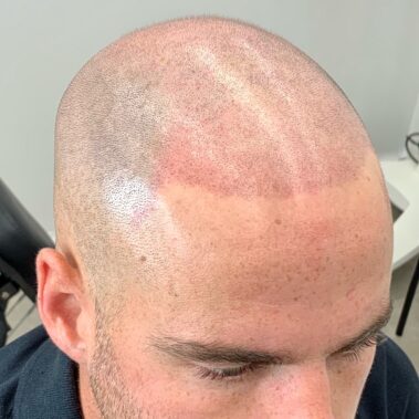 micropigmentación capilar valencia