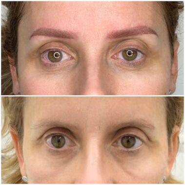 Micropigmentación, mujer antes y después