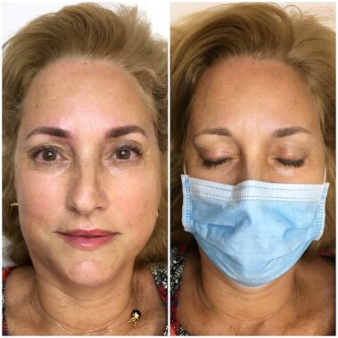 Micropigmentación, mujer antes y después