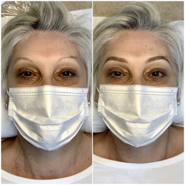 Micropigmentación, mujer antes y después